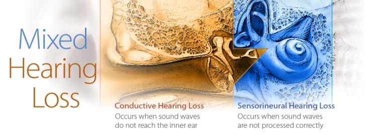 Mixed-Hearing-Loss-1040x376
